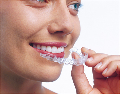 Invisalign top