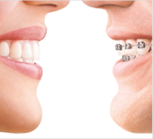 Invisalign